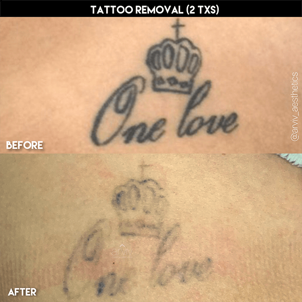 laser tattoo before and after 1