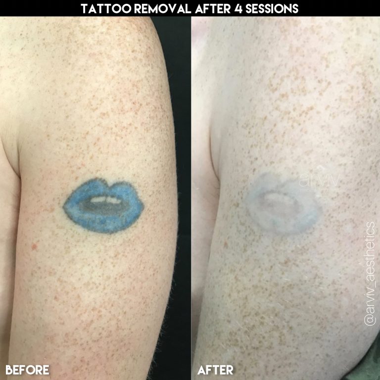 laser tattoo before and after 3