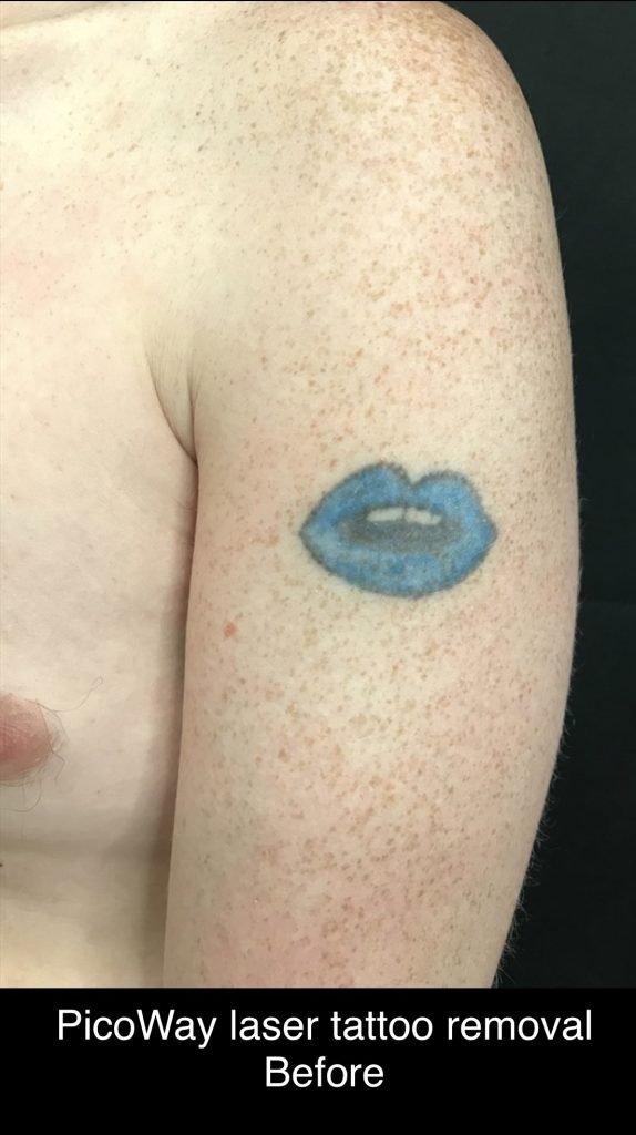 laser tattoo before and after 4