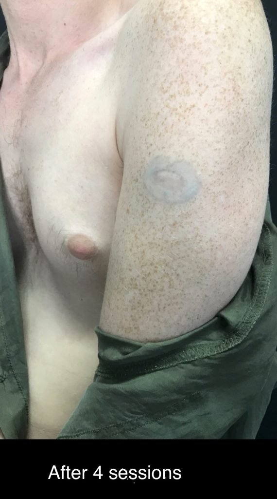 laser tattoo before and after 5