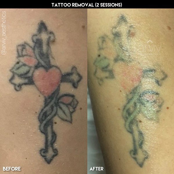 laster tattoo before and after 2